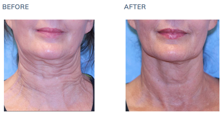 Sofwave™ Before After Neck Photos (Gastonia, NC)